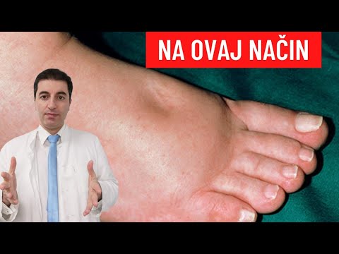 Video: Oticanje Noge Nakon Prijeloma - Uzroci Edema, Kako Ga Ukloniti?