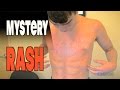 MYSTERY RASH After Strep Throat & Antibiotics: LIVE DIAGNOSIS with Dr. Paul