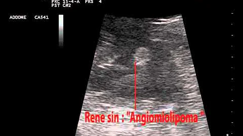 Che cosa è un Angiomiolipoma renale?