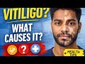 👉 “Vitiligo Explained: Causes, Symptoms &amp; Treatment”
