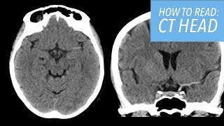 How to Read a CT Head: A Beginner's Approach