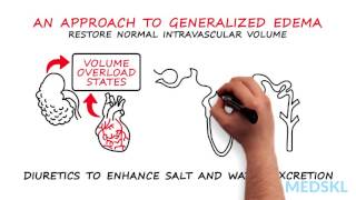 Nephrology – Generalized Edema: By Timothy Yau M.D. and Michael Connor M.D.