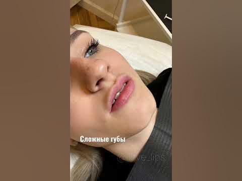 Сложные губ, Форма губ «Чайка» Одна процедура (1 мл) Juvederm 3 - YouTube