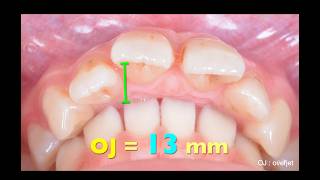 Solving Class II malocclusion with 13mm OJ by Damon Ultima｜【Chris Chang Ortho】CC870