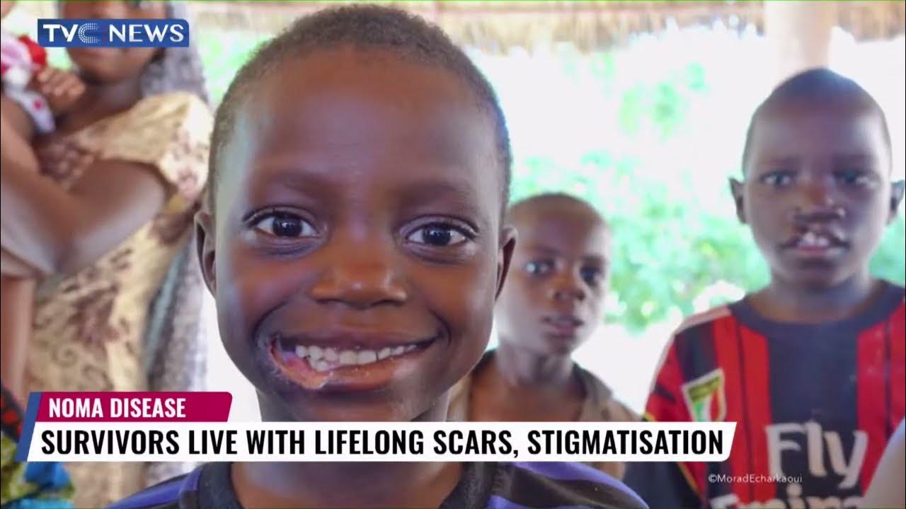 WATCH: How A Noma Disease Survivors Lives With Lifelong Scars, Stigmatisation