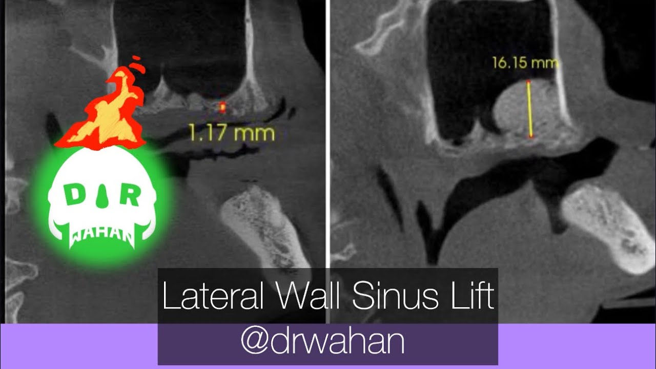 Lateral Wall Sinus Lift in Thin Bone drwahan YouTube