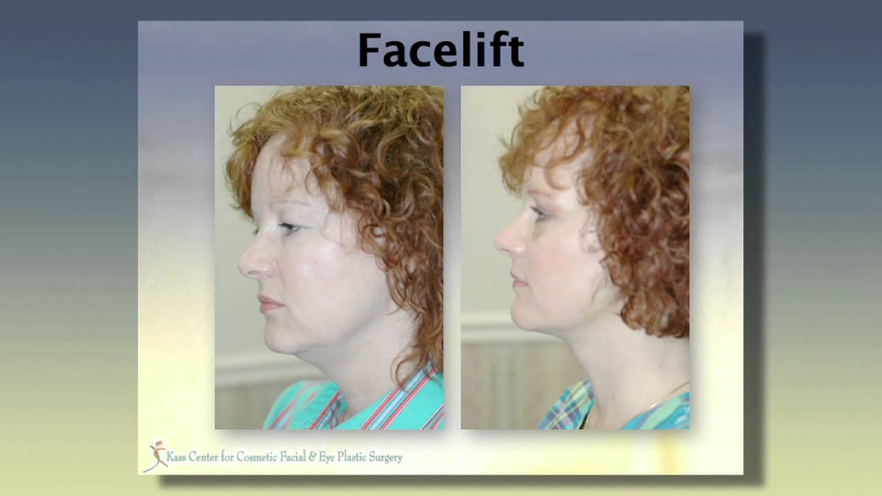 Face Lift YouTube