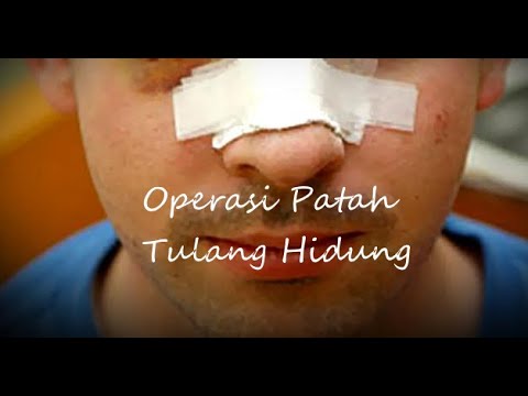 Video: Fraktur Hidung Dengan Dan Tanpa Perpindahan - Tanda, Pertolongan Pertama, Konsekuensi Dan Pengobatan Patah Tulang Hidung