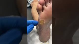 Thick Corn And Callus Removal From The Foot The Foot Of A Patient By A Podiatrist