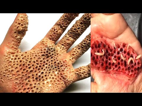 A Farmer Removed His Own Skin Cancer With A Pocket Knife! This Is What Happened To His Brain.