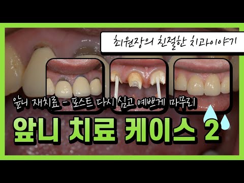 오래된 앞니를 재치료했던 케이스 2부입니다.