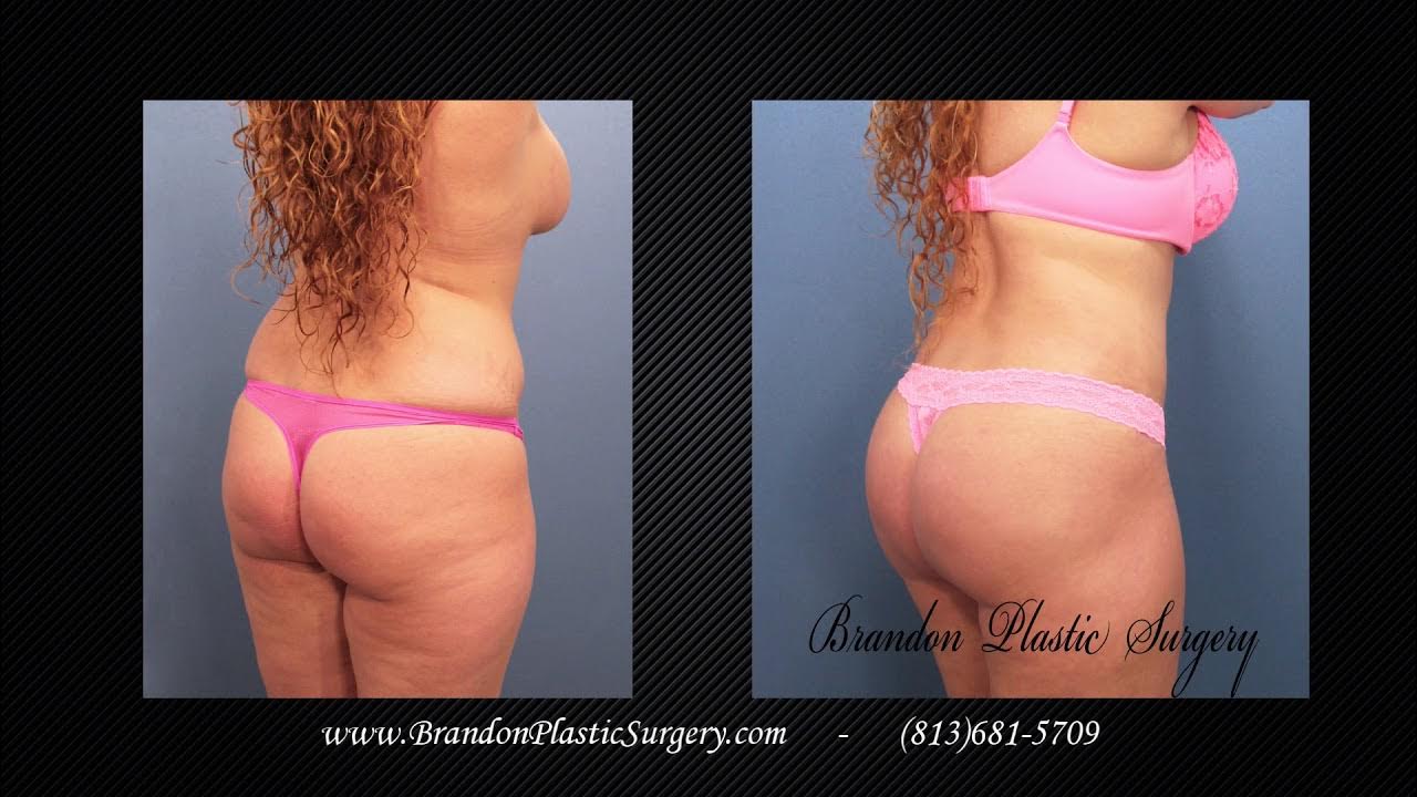 Liposuction with Stomach Etching 6 Pack Abs YouTube