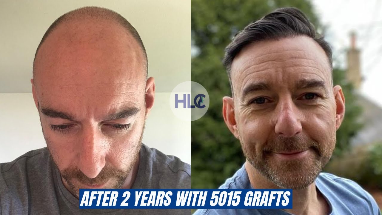 Witness Remarkable Hair Transplant Results: Before and After