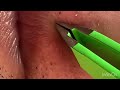 【Plucking facial hair】ずっと見ていられる闇雲のヒゲ抜き　2023 4 21（口元ヒゲ全部抜き）【Pull out the beard】