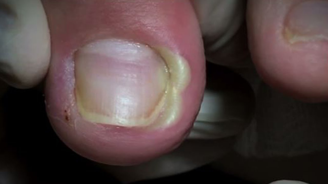 HOW TO CUT THICK TOENAILS, (👣) ingrown Cut nail tutorial Cleaning