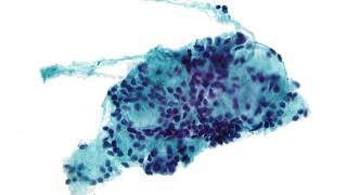 Needle aspiration biopsy | Wikipedia audio article