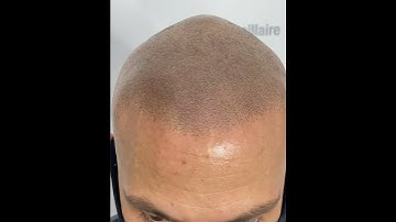 Scalp micropigmentation Montréal, Canada, transformation/ clinique MicroCapillaire