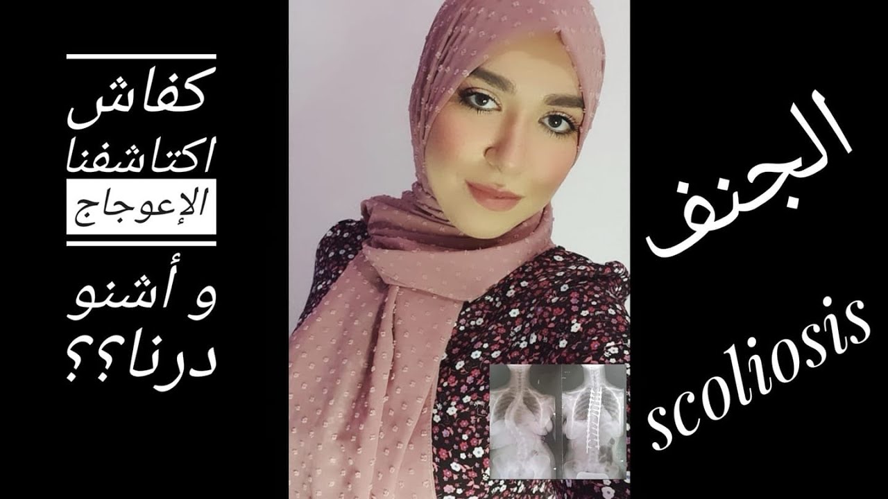 كفاش اكتاشفا الإعوجاج و أشنو درنا فالعلاج ديال الجنف / scoliose 🔩🔩❤❤💪