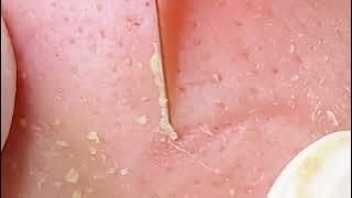 lt's really scary his blackhead is really big, we have to clean it out beauty spa cleaning🤞🐱‍🏍 #0122