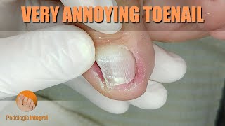 Very annoying toenail #podology #asmr