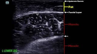 POCUS - Soft Tissue Ultrasound - Soft Tissue Edema screenshot 1