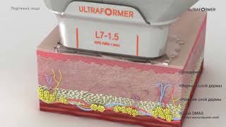 SMAS-ЛИФТИНГ ULTRAFORMER III