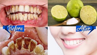 Cara Cepat Putihkan Gigi Plak Dan Karang Gigi Rontok Seketika