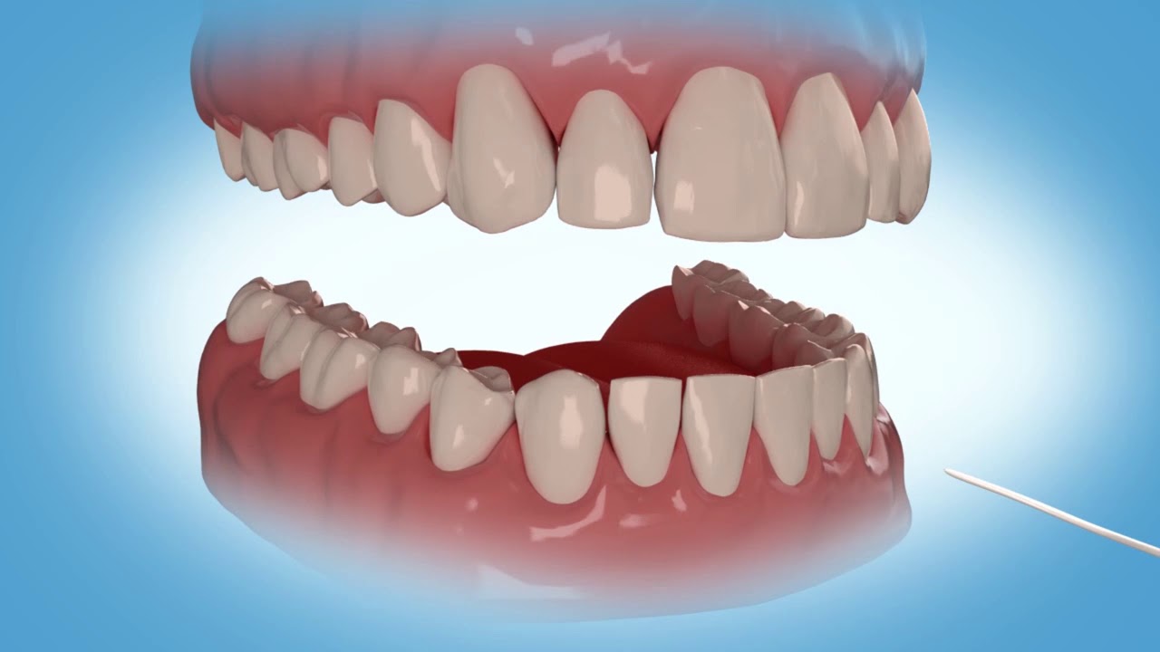 BONDED RETAINERS Spanish YouTube