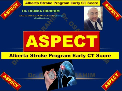 ASPECT Alberta Stroke Program Early CT Score