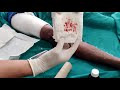 How to change dressing at home of skin graft  special class for nursing student post op wound care