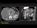 Abdominal radiology lecture ct of esophageal and gastric pathology