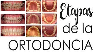 ETAPAS DE LA ORTODONCIA | FASES DEL TRATAMIENTO