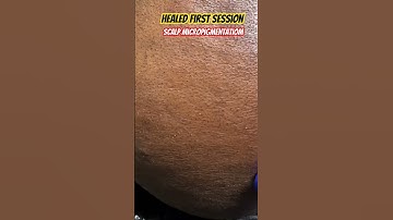 Follow me for complete results,scalp micropigmentation 8891426652 8078800335 #scalpmicropigmentation