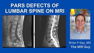 Pars defect on MRI