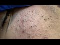 Deep Cleansing Techniques for Acne Prone Skin | Blackheads and Pimple Removal Remedies