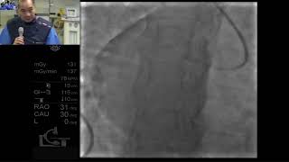 A case of heavily calcified LAD ostial and RCA stenosis (Mirror Image Dextrocardia)