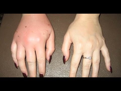 Какие последствия может повлечь за собой ОБЫЧНАЯ КОШАЧЬЯ ЦАРАПИНА!