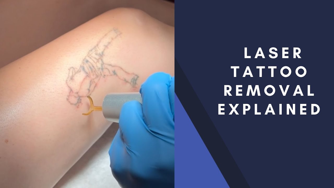 Get Rid Tattoo Review - A Natural Tattoo Removal Guide | Blush