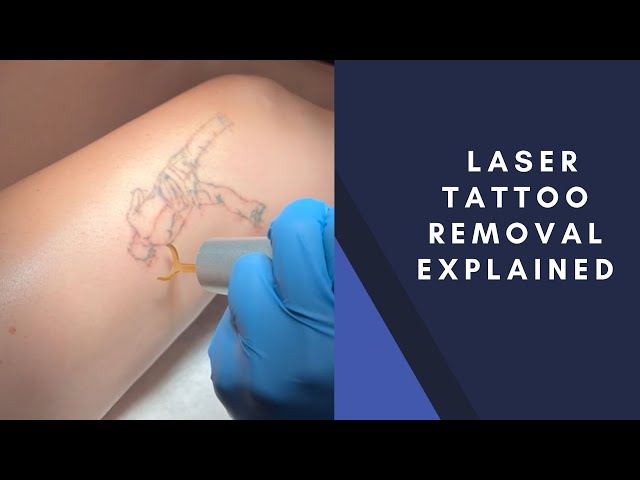 The Tattoo Removal CoLaser Tattoo Removal Adelaide