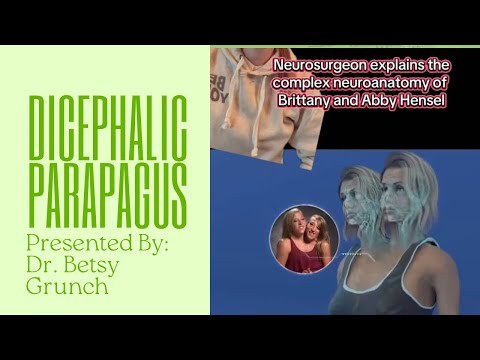 Dicephalic parapagus is a rare form of partial twinning with two heads side by side on one torso.