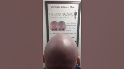 3d Scalp Micropigmentation Natural Stunning Results with Chris