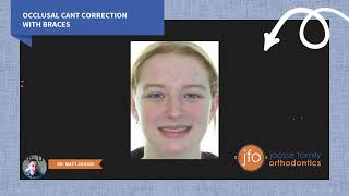 Occlusal Cant Correction with Braces | Joosse Family Orthodontics | Williamsburg, VA