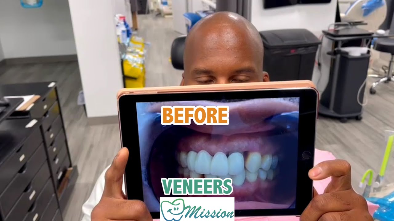 Flying to Miami to get Veneers