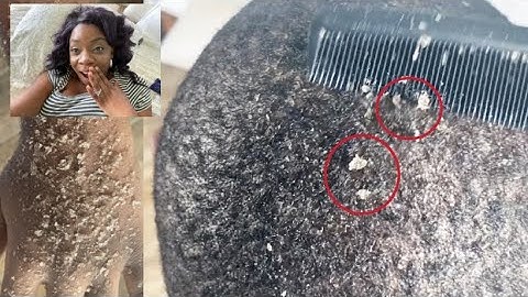 REACTING TO EXTREME DANDRUFF SCRATCHING | Dry Itchy Scalp & Huge Flakes