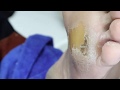 Ep_993 Foot skin removal part 1 👣 มาขูดหนังด้านกัน 1 😖  (This clip from Thailand)