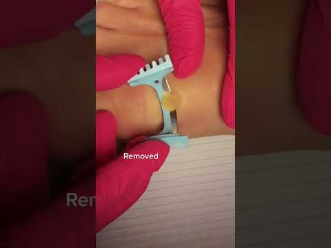 Wart On The Foot Removal Shorts