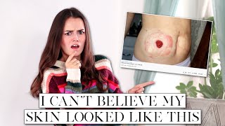 How I Healed the Skin Around My Stoma | Let