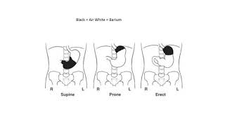 Radiographic Positioning of the Stomach