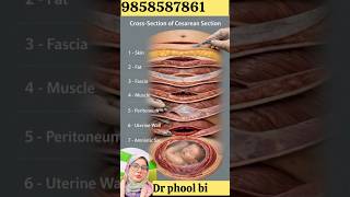 C-Section of Ceasarean section @Drphoolbirampuri #motivation #pregnancy #health #viralvideo #ytshort
