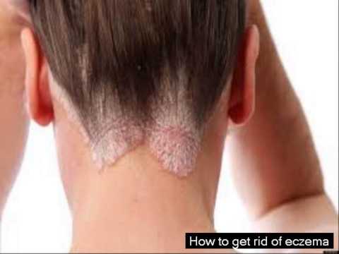 how to get rid of eczema under eyes 